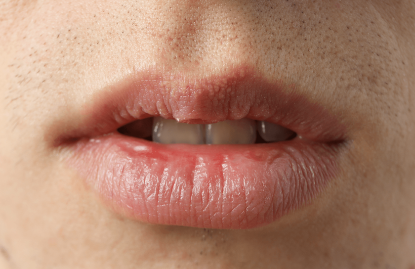 Nahaufnahme eines Mundes mit trockenen, rissigen Lippen und kurzem Bartwuchs